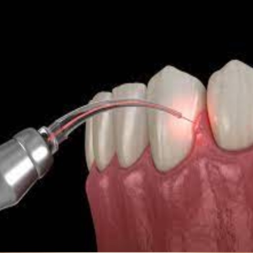 Depigmentation of Gum